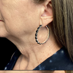 Facelift Before & After Patient #4628
