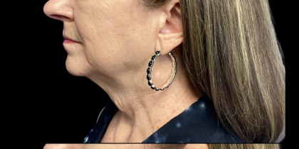 Facelift Before & After Patient #4628