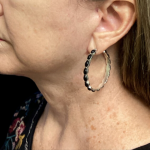 Facelift Before & After Patient #4628