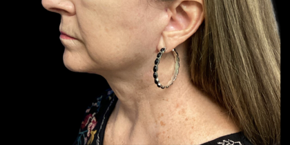Facelift Before & After Patient #4628