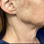Facelift Before & After Patient #4629