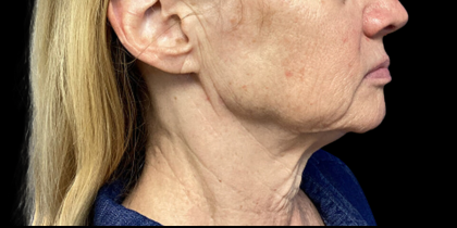 Facelift Before & After Patient #4629