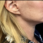 Facelift Before & After Patient #4629