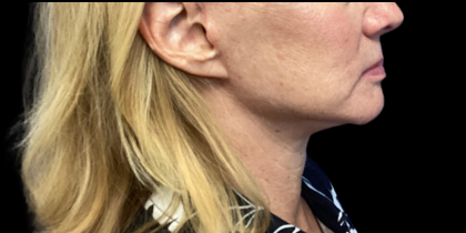 Facelift Before & After Patient #4629