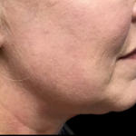 Facelift Before & After Patient #4631