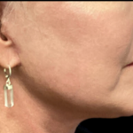 Facelift Before & After Patient #4631