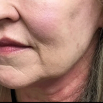 Facelift Before & After Patient #4631