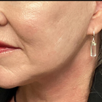 Facelift Before & After Patient #4631