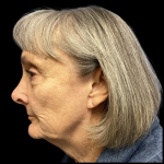 Facelift Before & After Patient #4663