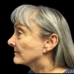 Facelift Before & After Patient #4663