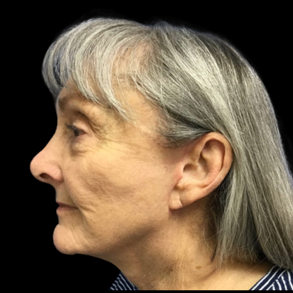 Facelift Before & After Patient #4663