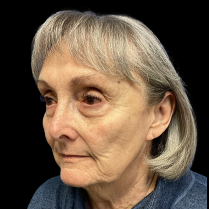 Facelift Before & After Patient #4663