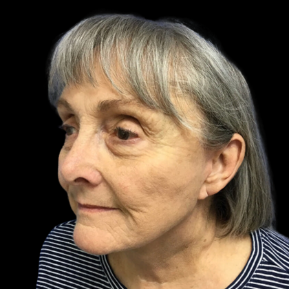 Facelift Before & After Patient #4663