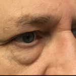 Blepharoplasty Before & After Patient #4630