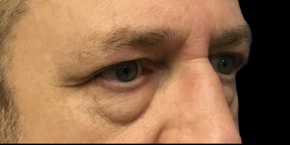 Blepharoplasty Before & After Patient #4630