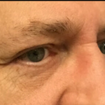 Blepharoplasty Before & After Patient #4630