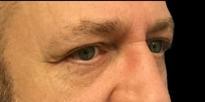 Blepharoplasty Before & After Patient #4630