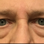 Blepharoplasty Before & After Patient #4630