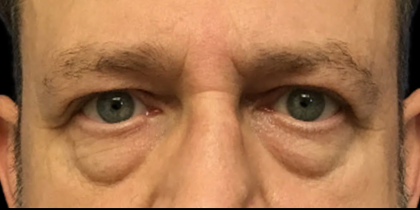 Blepharoplasty Before & After Patient #4630