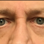 Blepharoplasty Before & After Patient #4630