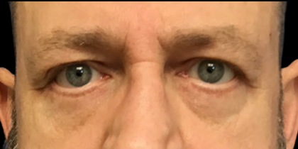 Blepharoplasty Before & After Patient #4630