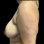 Breast Augmentation Before & After Patient #4571