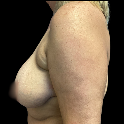 Breast Augmentation Before & After Patient #4571