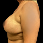 Breast Augmentation Before & After Patient #4571