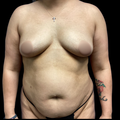Mommy Makeover Before & After Patient #4573