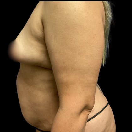 Mommy Makeover Before & After Patient #4573