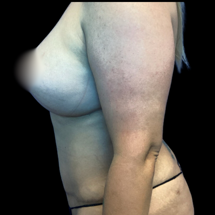 Mommy Makeover Before & After Patient #4573