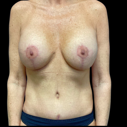 Mommy Makeover Before & After Patient #4572