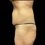 Mommy Makeover Before & After Patient #4572