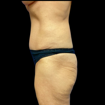 Mommy Makeover Before & After Patient #4572