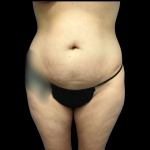 Mommy Makeover Before & After Patient #4574