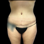 Mommy Makeover Before & After Patient #4574