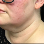 Neck Lift Before & After Patient #4632