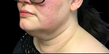 Neck Lift Before & After Patient #4632