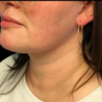 Neck Lift Before & After Patient #4632
