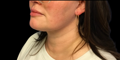 Neck Lift Before & After Patient #4632