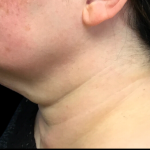 Neck Lift Before & After Patient #4632