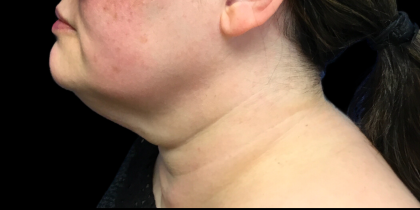 Neck Lift Before & After Patient #4632