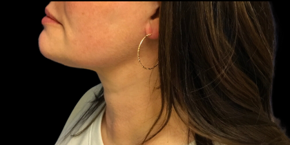 Neck Lift Before & After Patient #4632