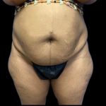 Tummy Tuck Before & After Patient #4575