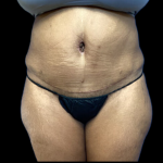 Tummy Tuck Before & After Patient #4575