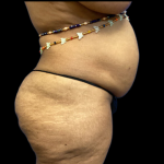 Tummy Tuck Before & After Patient #4575