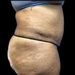 Tummy Tuck Before & After Patient #4575