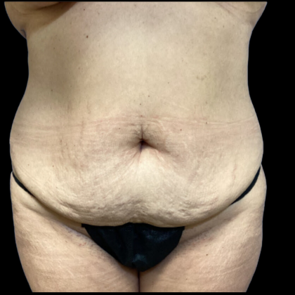 Tummy Tuck Before & After Patient #4576