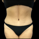 Tummy Tuck Before & After Patient #4576