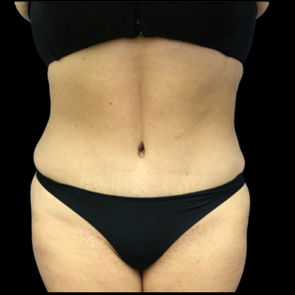 Tummy Tuck Before & After Patient #4576